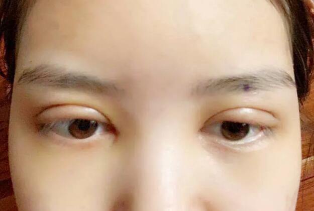 鄭州壹加壹王洛生全切雙眼皮案例術(shù)后一周 鄭州壹加壹王洛生全切雙眼皮案例術(shù)后一周