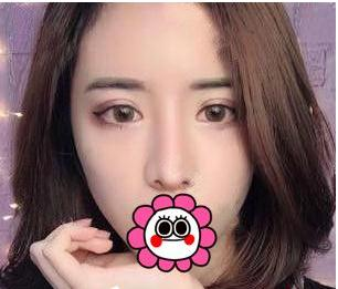 有“鼻王”之稱的楊群申做鼻子到底怎么樣？隆鼻前后圖片