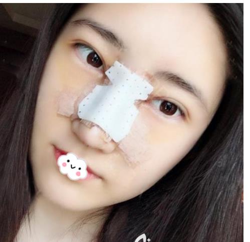 長春亞韓整形假體隆鼻案例術(shù)后兩天 長春亞韓整形假體隆鼻案例術(shù)后兩天