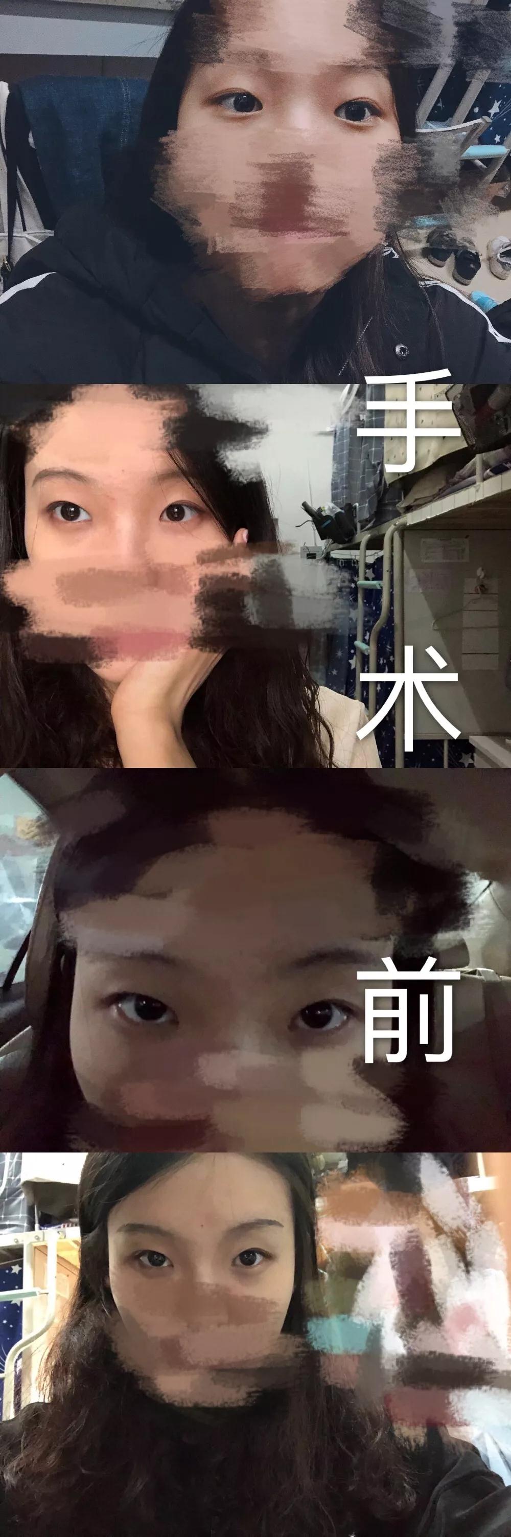 北京藝星張順慶雙眼皮案例術(shù)前