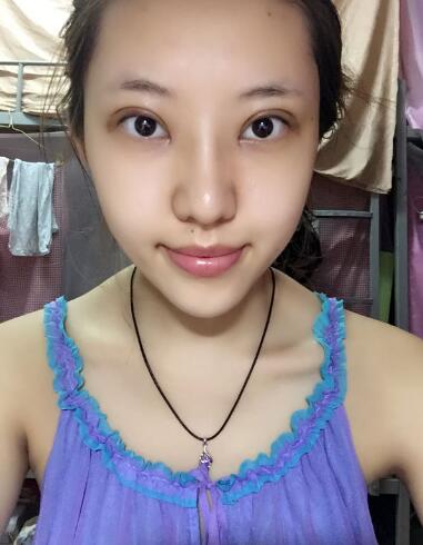 第四軍醫(yī)大學(xué)唐都醫(yī)院李望舟雙眼皮案例術(shù)后一個月