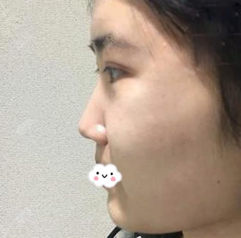 長春亞韓整形假體隆鼻案例術(shù)前側(cè)面 長春亞韓整形假體隆鼻案例術(shù)前側(cè)面