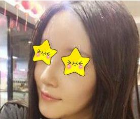 長沙亞韓鄭京湘隆鼻術(shù)后一個(gè)月