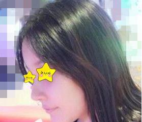 隆鼻真實(shí)案例，長(zhǎng)沙亞韓鄭京湘隆鼻前后對(duì)比圖片