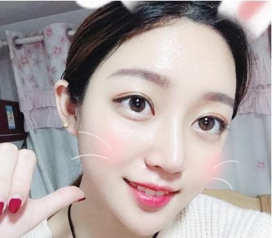 宜昌奧萊楊群申超體隆鼻案例分享，有圖