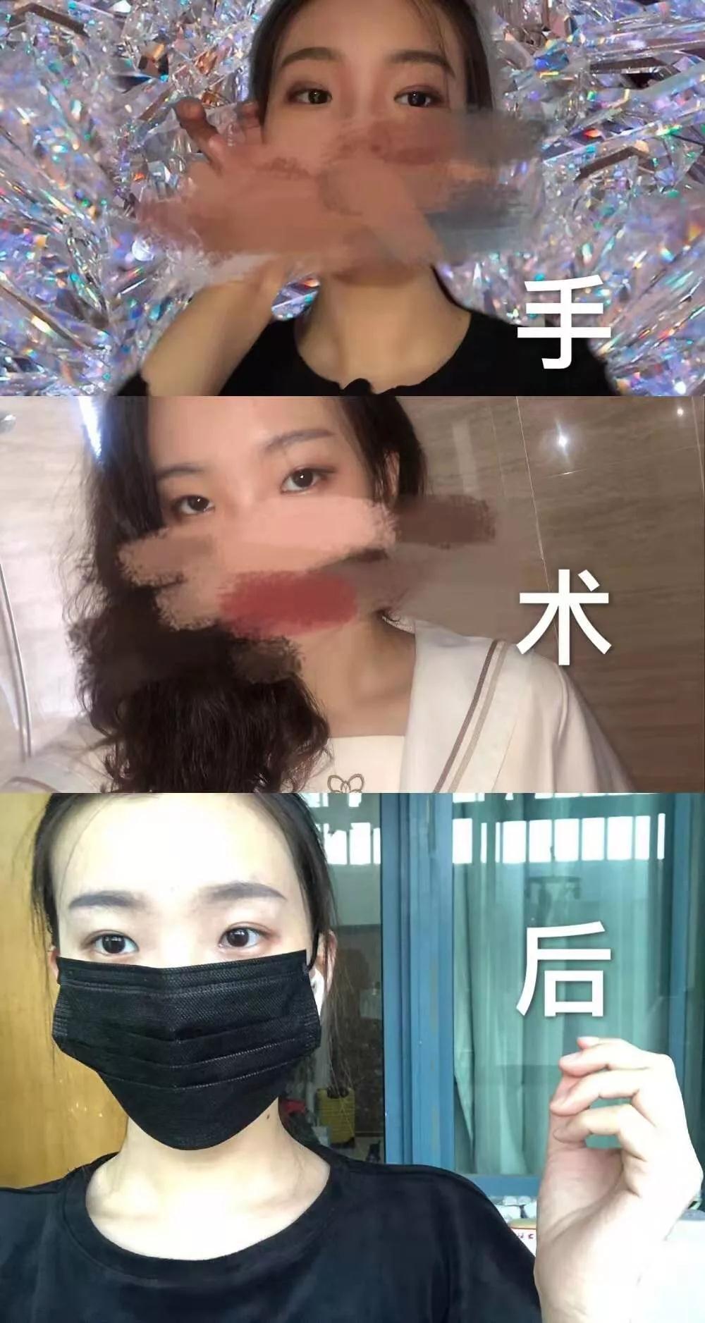 北京藝星張順慶雙眼皮案例術(shù)后效果