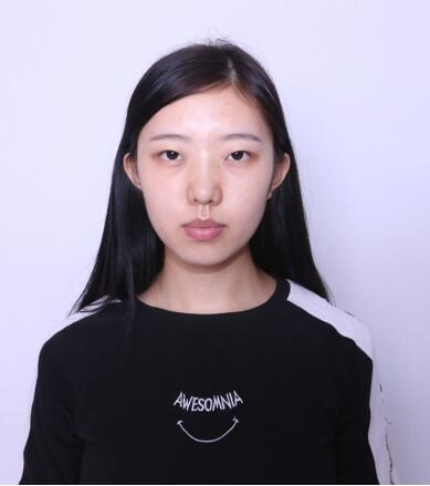 做雙眼皮案例，第四軍醫(yī)大學(xué)唐都醫(yī)院李望舟雙眼皮案例圖片