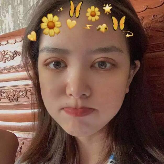 鄭州壹加壹王洛生全切雙眼皮案例術(shù)后半個(gè)月 鄭州壹加壹王洛生全切雙眼皮案例術(shù)后半個(gè)月