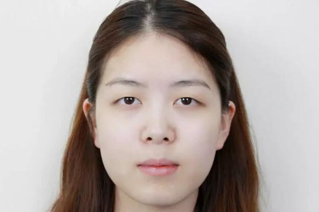 做雙眼皮案例，鄭州壹加壹王洛生全切雙眼皮案例圖片