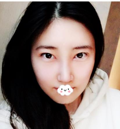 假體隆鼻假嗎？假體隆鼻三個月效果分享