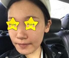 長沙亞韓鄭京湘隆鼻案例術(shù)前