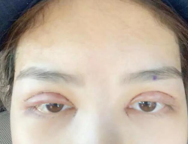 鄭州壹加壹王洛生全切雙眼皮案例術(shù)后第二天 鄭州壹加壹王洛生全切雙眼皮案例術(shù)后第二天