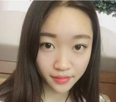 宜昌奧萊楊群申超體隆鼻案例分享，有圖