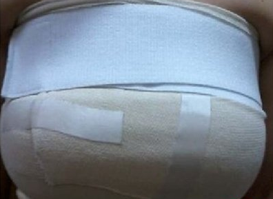 上海美萊醫(yī)療美容門診部做假體隆胸手術(shù)后包裹狀態(tài)