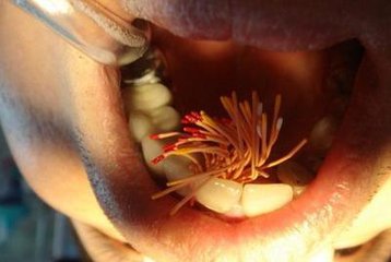 撫州英倫口腔根管治療怎么樣？根管治療有什么優(yōu)點(diǎn)？