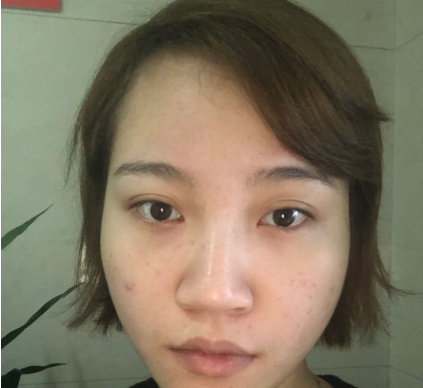 上海時(shí)光整形外科醫(yī)院繆勇鼻綜合案例效果分享