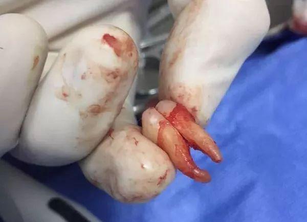 福州登特口腔拔智齒有哪些利弊？拔智齒有哪些情況？