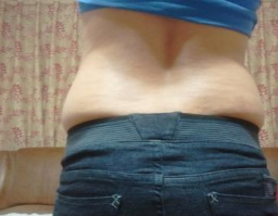 東莞華美醫(yī)療美容醫(yī)院劉潤貴做腰腹吸脂案例效果分享