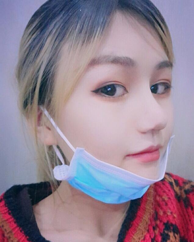 成都蜀尚蓉雅美容整形醫(yī)院做鼻綜合術(shù)后恢復(fù)好的情況 成都蜀尚蓉雅美容整形醫(yī)院做鼻綜合術(shù)后恢復(fù)好的情況