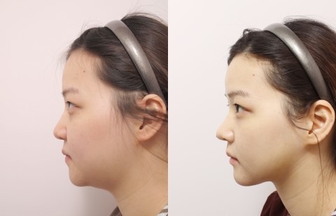 面部吸脂最好的辦法是什么？做一次面部吸脂多少錢？