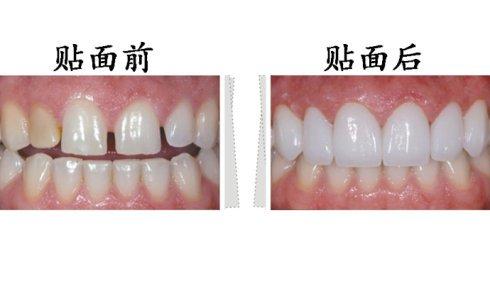 東莞拜博口腔瓷貼面有什么優(yōu)勢？瓷貼面有副作用嗎？