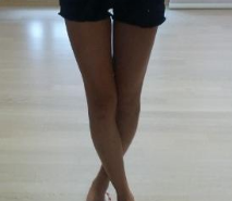 東莞華美醫(yī)療美容醫(yī)院劉潤貴做腰腹吸脂案例效果分享