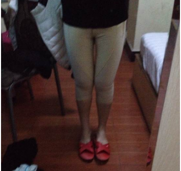 東莞華美醫(yī)療美容醫(yī)院做大腿吸脂手術(shù)后的兩個(gè)月 東莞華美醫(yī)療美容醫(yī)院做大腿吸脂手術(shù)后的兩個(gè)月