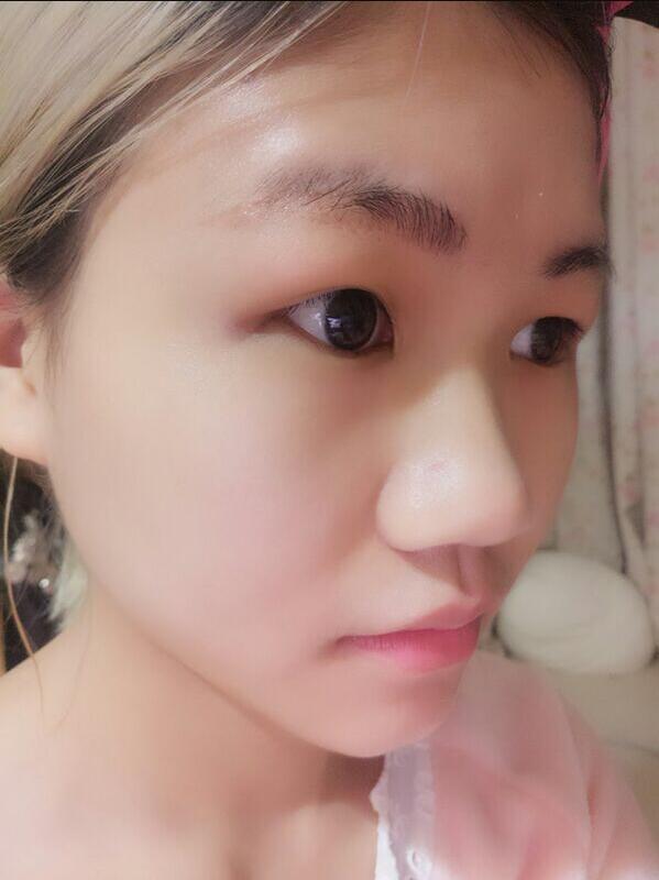 成都蜀尚蓉雅美容整形醫(yī)院做鼻綜合手術(shù)前的鼻子 成都蜀尚蓉雅美容整形醫(yī)院做鼻綜合手術(shù)前的鼻子