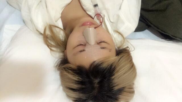 成都蜀尚蓉雅美容整形醫(yī)院做鼻綜合手術(shù)剛剛結(jié)束后 成都蜀尚蓉雅美容整形醫(yī)院做鼻綜合手術(shù)剛剛結(jié)束后