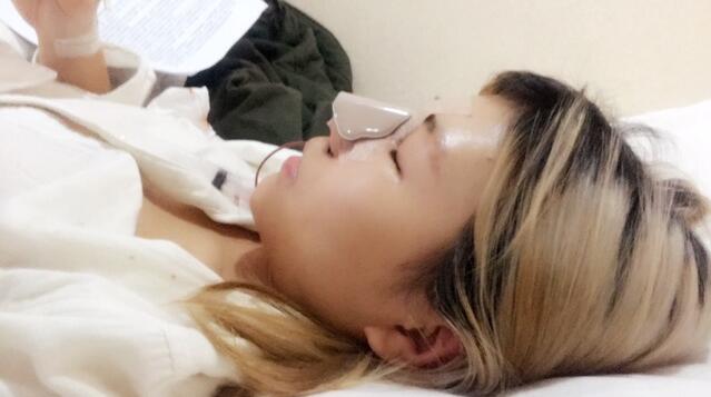 成都蜀尚蓉雅美容整形醫(yī)院做鼻綜合手術(shù)剛剛結(jié)束后的側(cè)面 成都蜀尚蓉雅美容整形醫(yī)院做鼻綜合手術(shù)剛剛結(jié)束后的側(cè)面