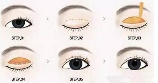 哈爾濱第一醫(yī)院切開雙眼皮多少錢？切開雙眼皮如何恢復(fù)？