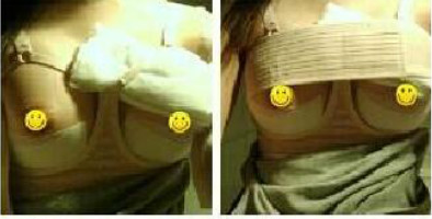 長(zhǎng)沙愛(ài)思特醫(yī)療美容醫(yī)院做假體隆胸術(shù)后一個(gè)月