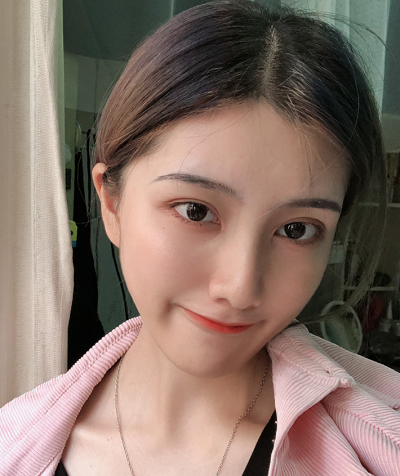 上海港華醫(yī)療美容醫(yī)院做隆鼻手術(shù)后的最終效果