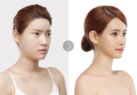 自體脂肪填充眉弓安全嗎？自體脂肪填充是永久的嗎？