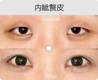 哈爾濱成美整形內(nèi)眥贅皮矯正怎么樣有哪幾種手術(shù)方法？