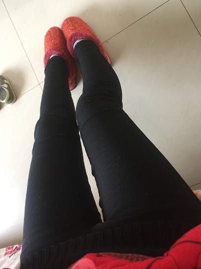 蘇州圣愛(ài)醫(yī)院醫(yī)療美容科做大腿吸脂手術(shù)后的日常 蘇州圣愛(ài)醫(yī)院醫(yī)療美容科做大腿吸脂手術(shù)后的日常