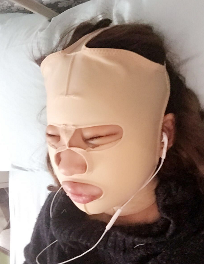 北京京民醫(yī)院（原釣魚臺醫(yī)院）整形外科做下頜骨手術(shù)后的恢復(fù)情況